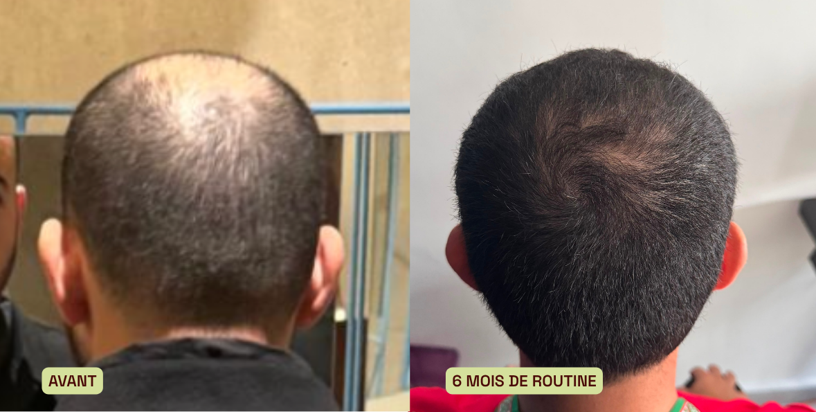 avant après reda