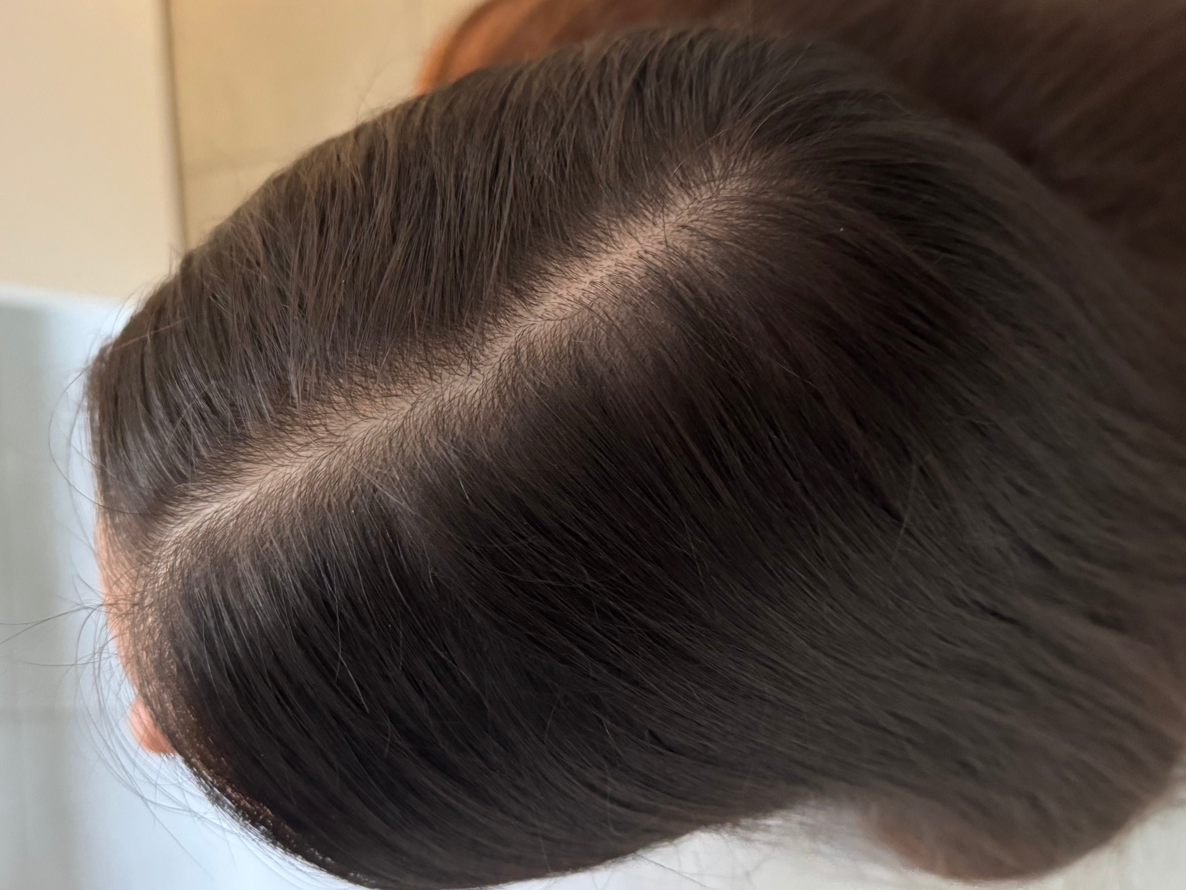 cuir chevelu d'une femme