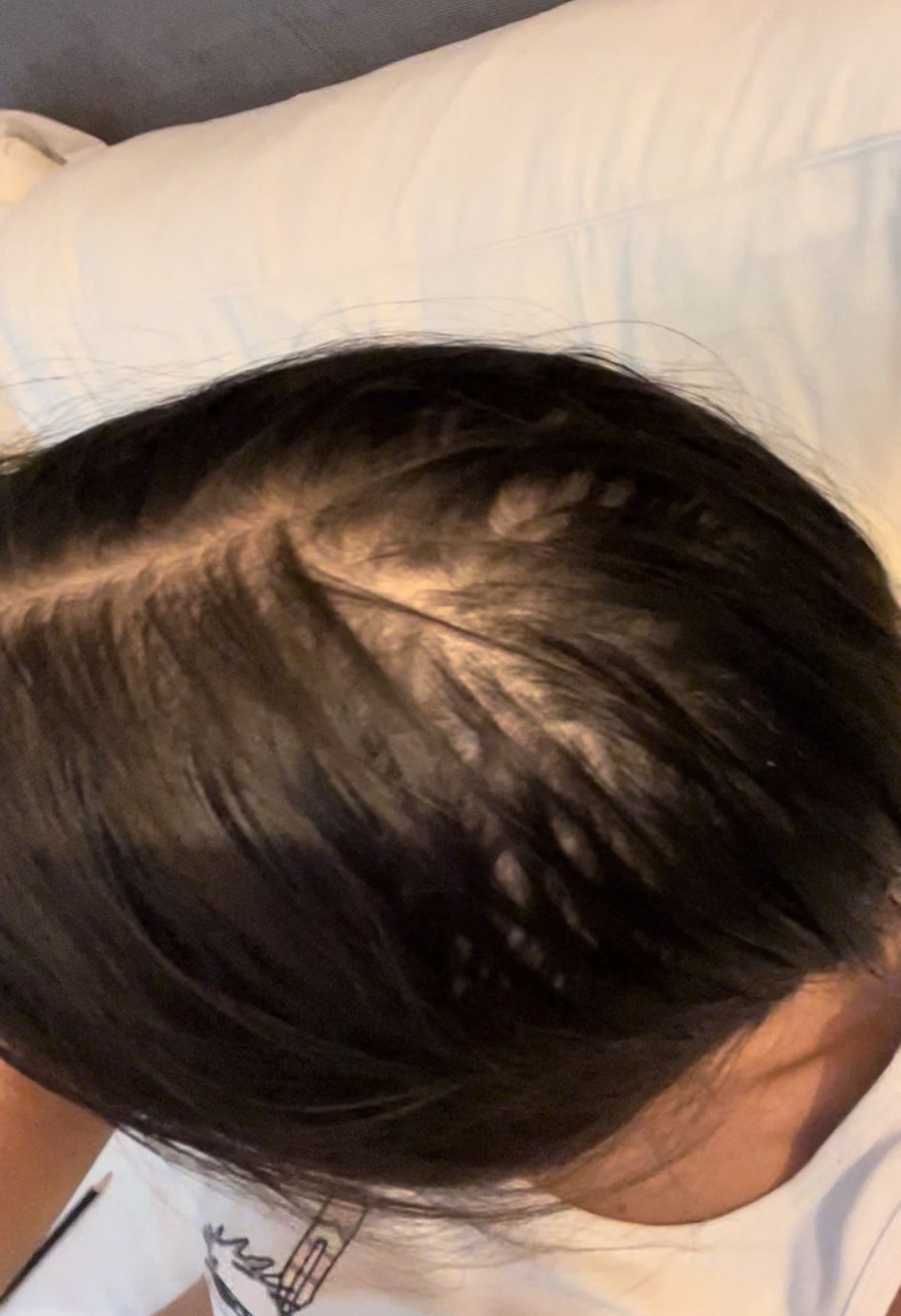 cuir chevelu d'une femme dégarnie